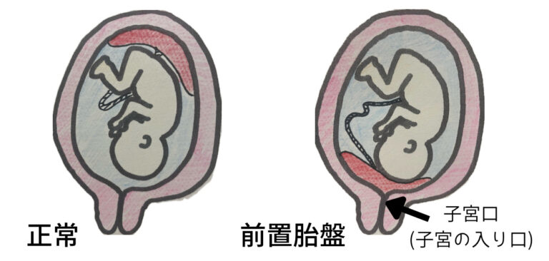 前置胎盤や低置胎盤と診断されたら？妊娠中の注意点や出産準備・出産方法について解説！ あなただけの Only One 助産師